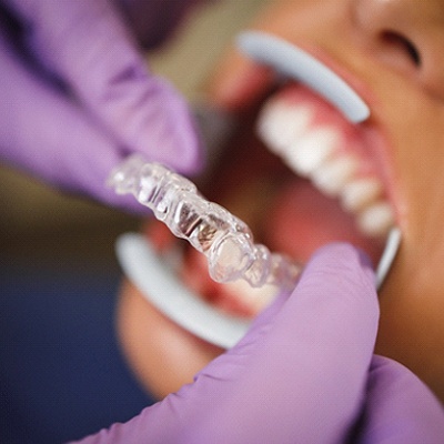 Orthodontist in Heath placing Invisalign aligners on patient