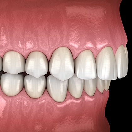 Illustration of crowded teeth