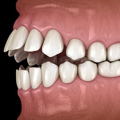 Illustration of an open bite