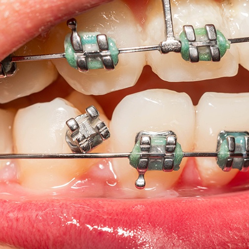a broken braces bracket