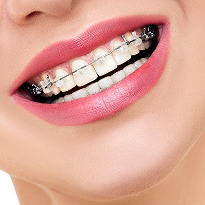 How to Choose the Best Orthodontist in Newark, OH