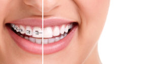close-up of a smile with braces