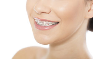 pretty woman smiling with braces