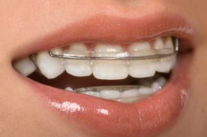 young woman smiling wearing braces