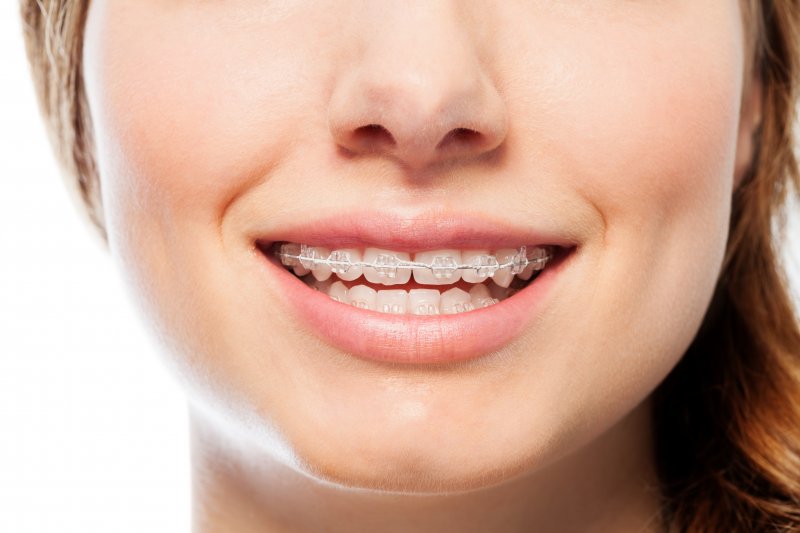 Woman in clear braces smiling.