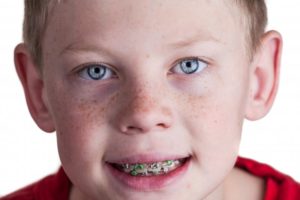 boy blue shirt in braces smiling