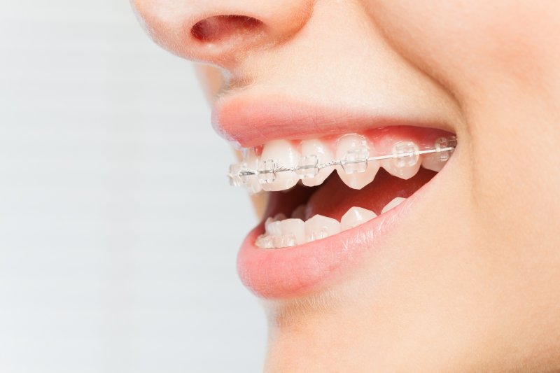 Woman smiling with braces on teeth.