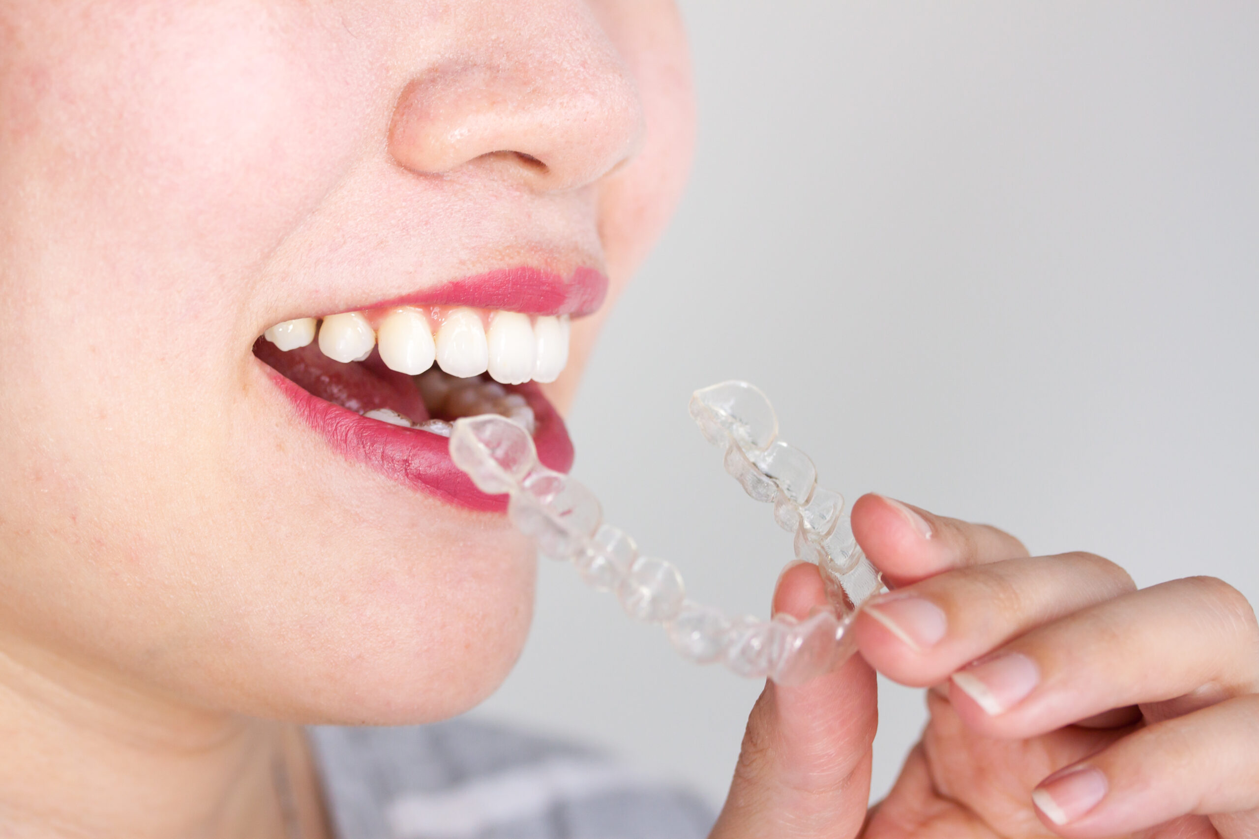 Woman smiling inserting Invisalign aligner.