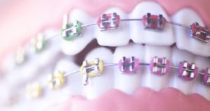 Up-close smile of teeth with braces