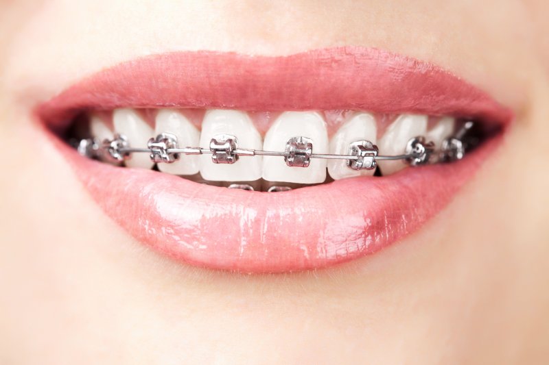 Attractive woman wearing braces smiling.