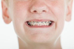 young boy smiling with braces