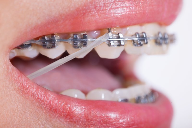 Closeup of braces.