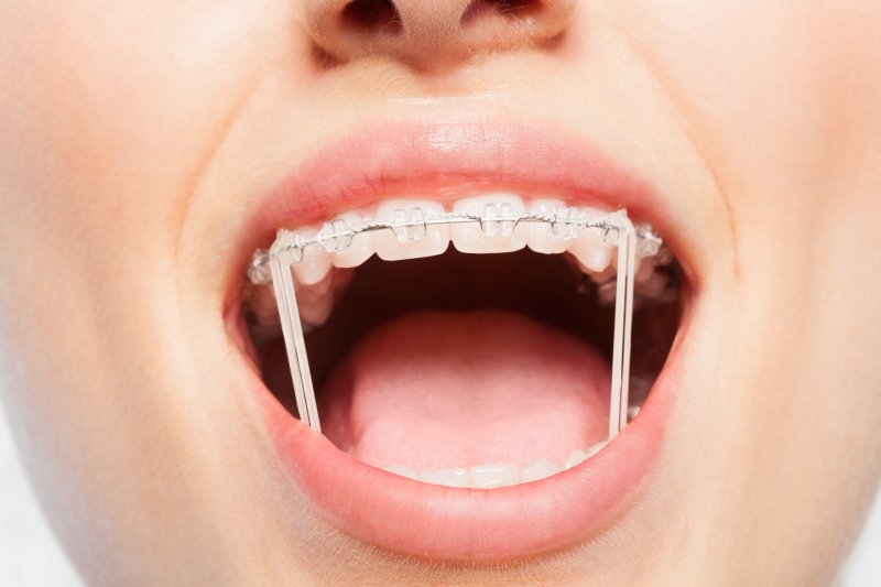 an up-close image of a person wearing rubber bands on braces