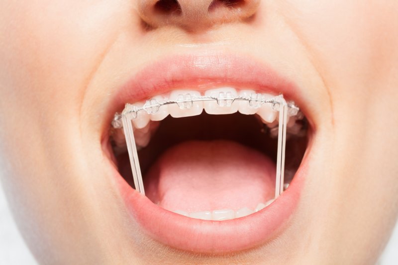 What Rubber Bands on Braces Do