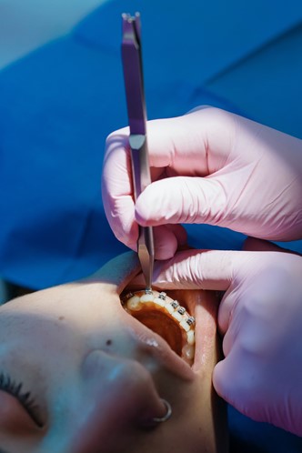 Woman having braces applied to teeth.