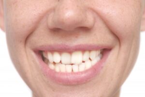 an up-close image of a person with crooked teeth