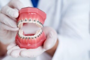 Dentist holding a model of teeth with braces in the foreground.