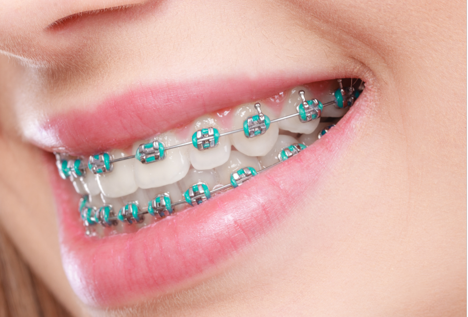 Close up of woman's blue braces.